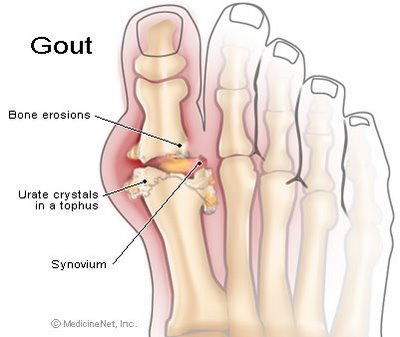 [Image: gout.jpg]