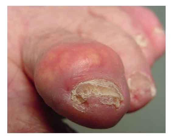 Bệnh gout đến từ đâu? Gout3